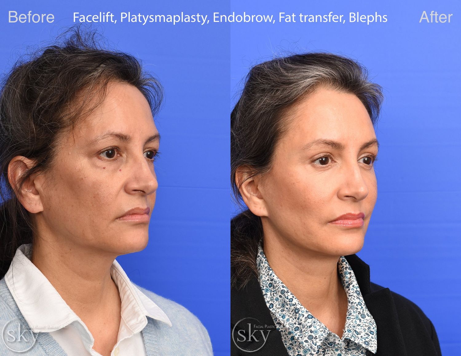 Facelift Before & After