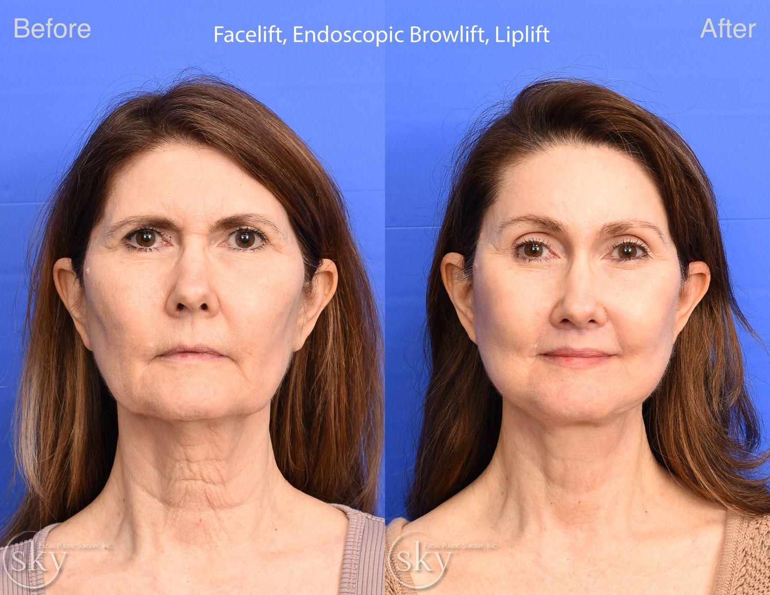 Facelift Before & After