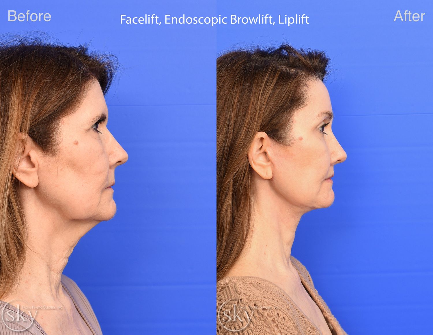Facelift Before & After