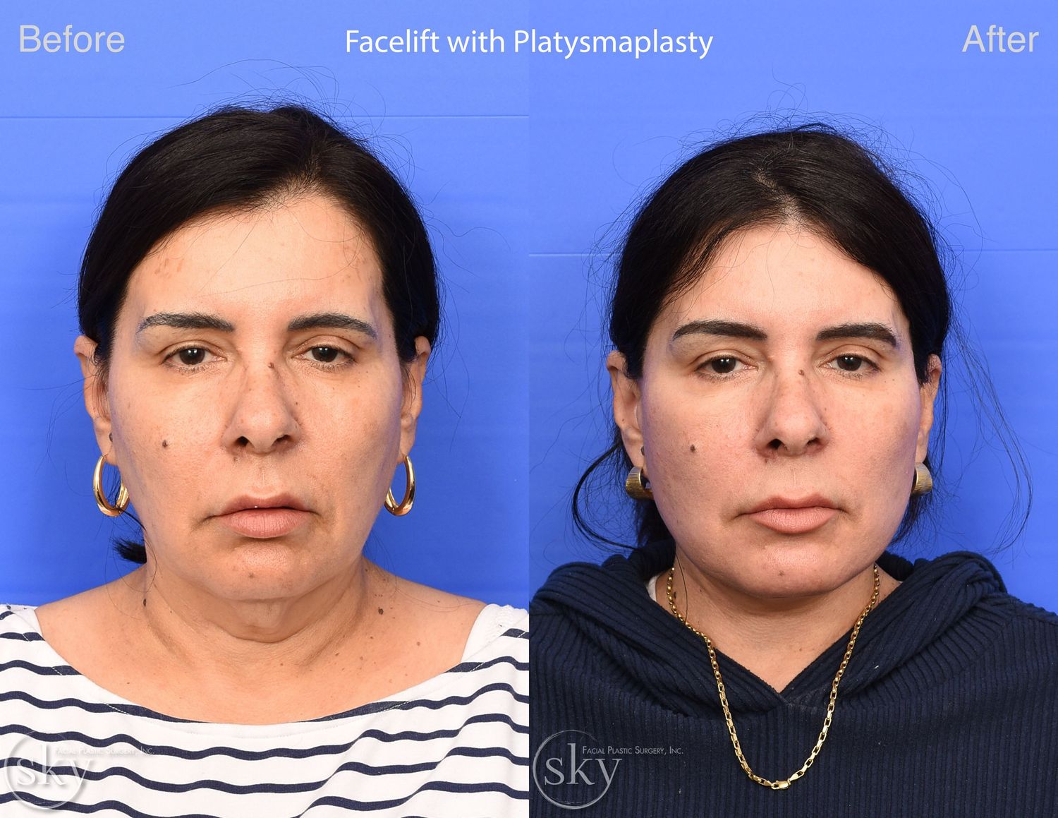 Facelift Before & After