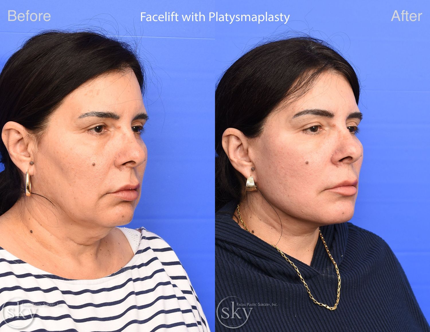 Facelift Before & After