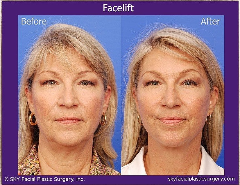 Facelift Before & After