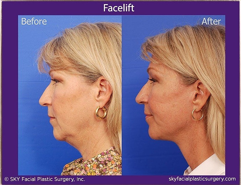 Facelift Before & After