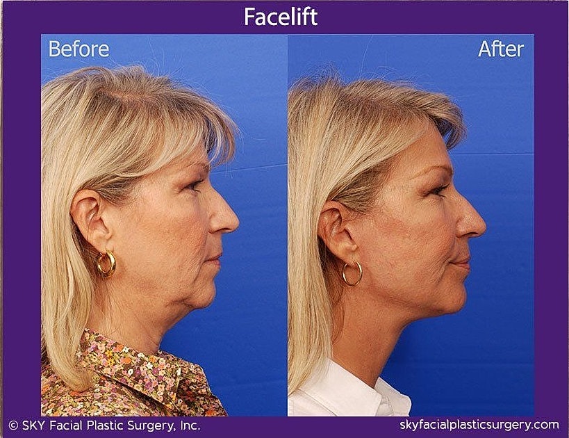Facelift Before & After