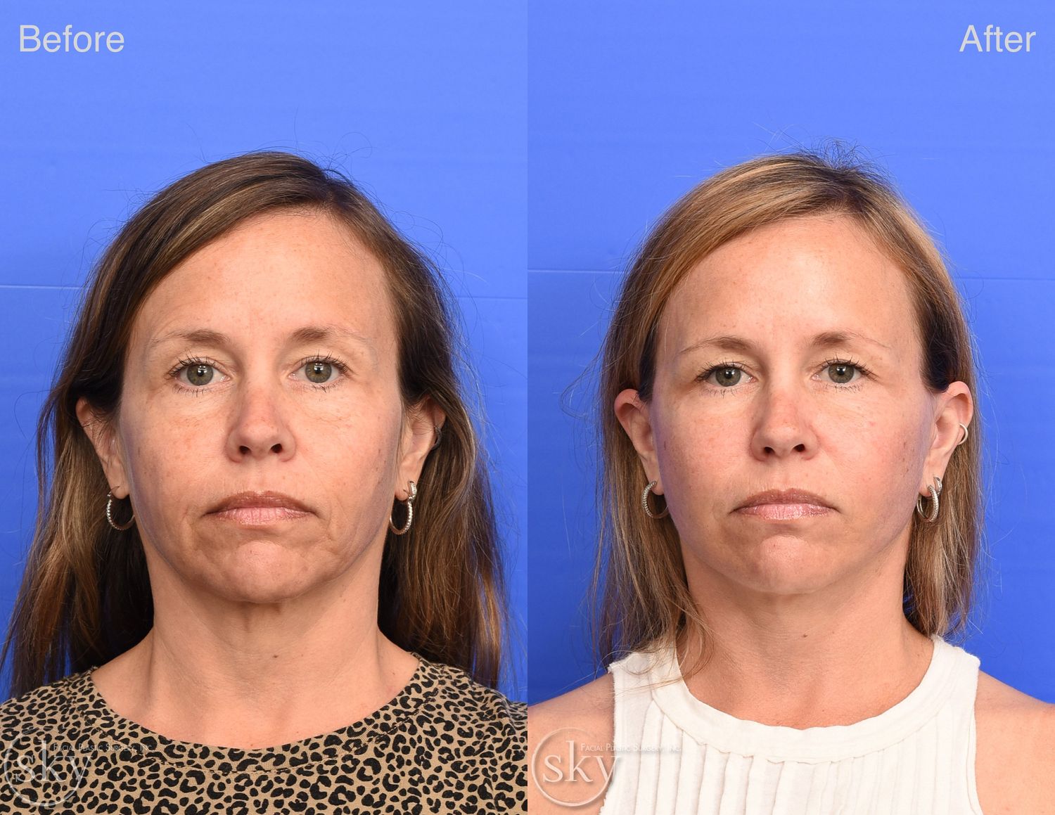 Facelift Before & After