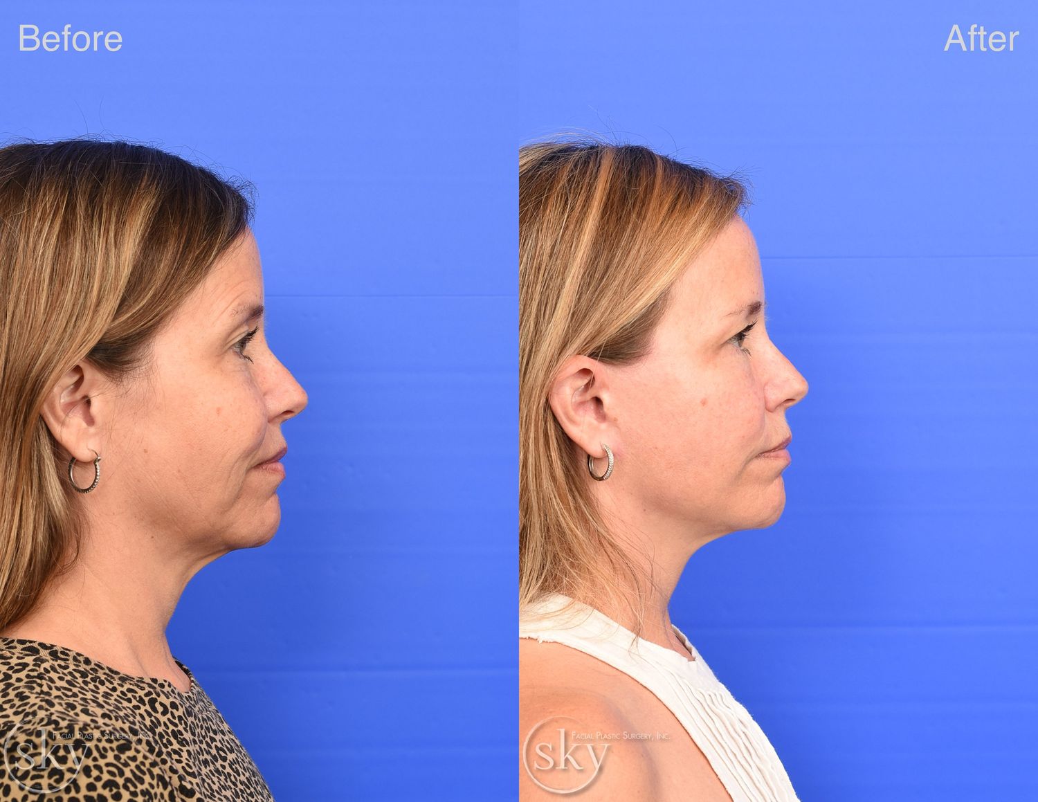 Facelift Before & After