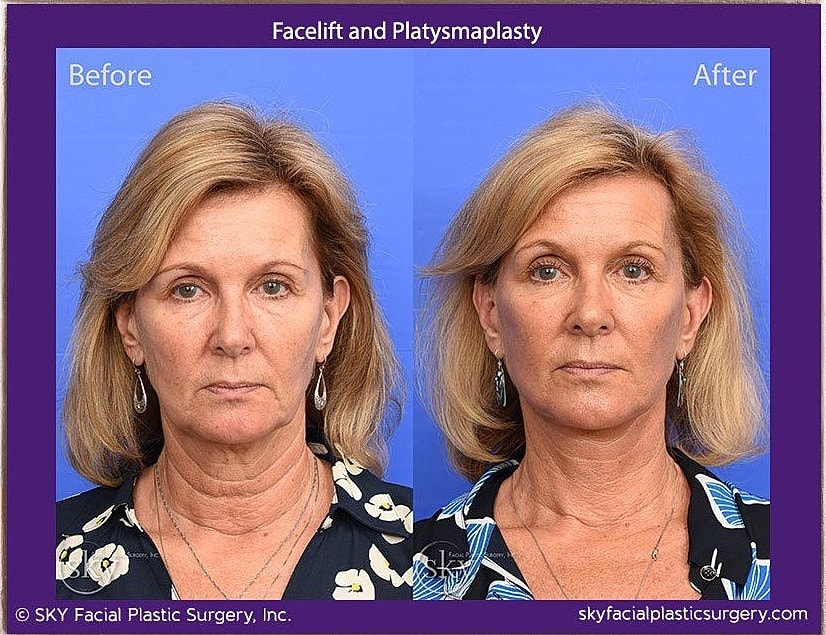 Facelift Before & After