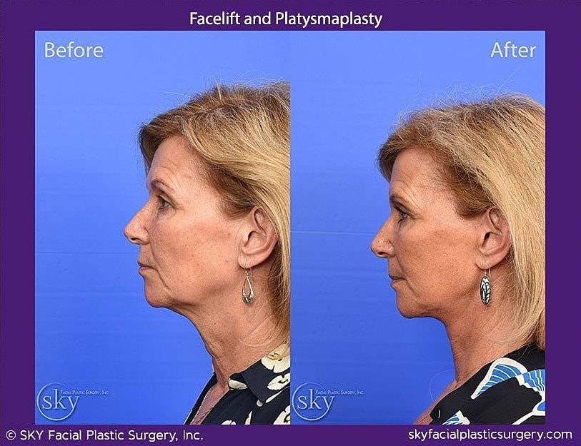 Facelift Before & After