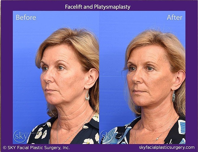 Facelift Before & After