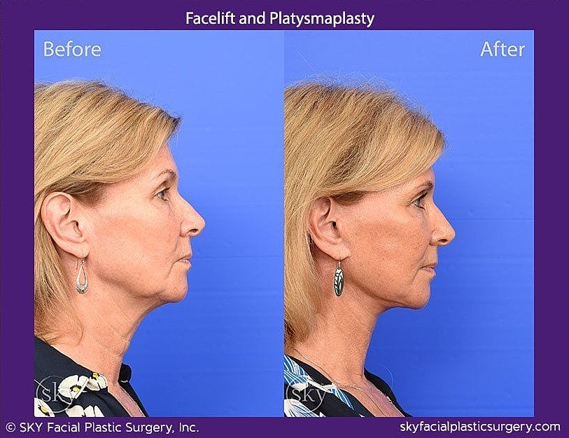 Facelift Before & After