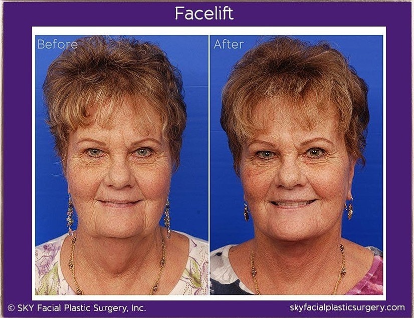 Facelift Before & After