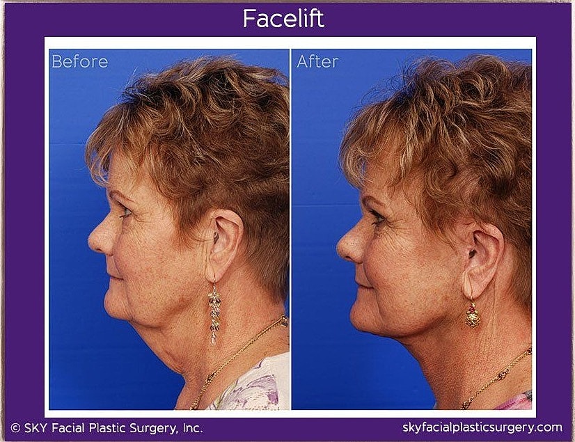 Facelift Before & After