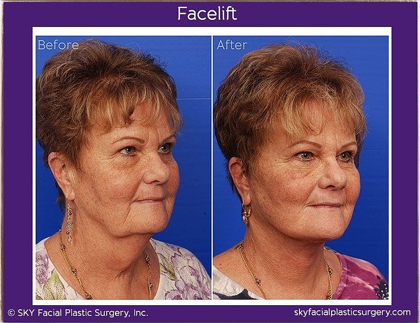 Facelift Before & After