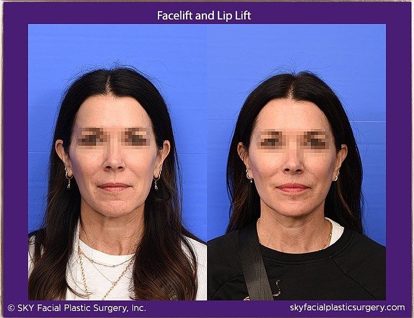 Facelift Before & After