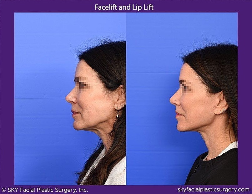 Facelift Before & After