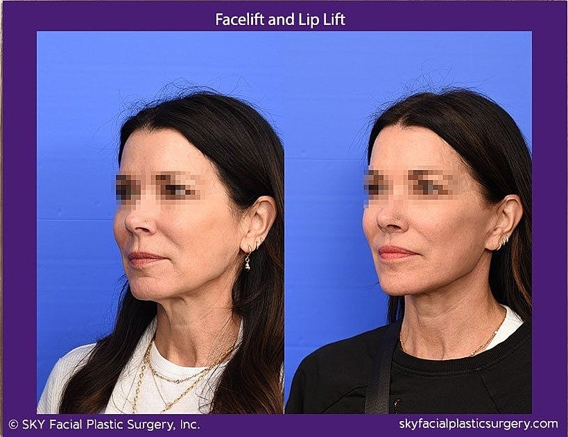 Facelift Before & After