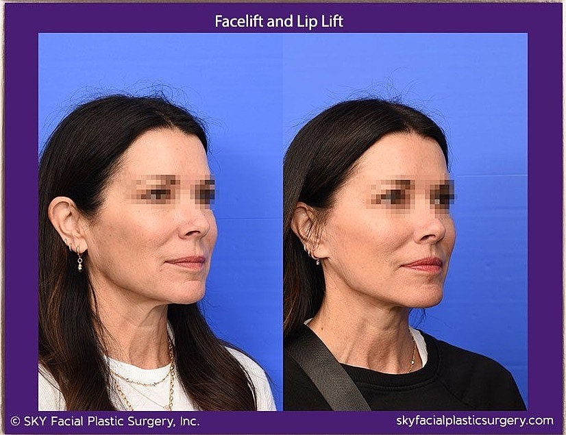 Facelift Before & After