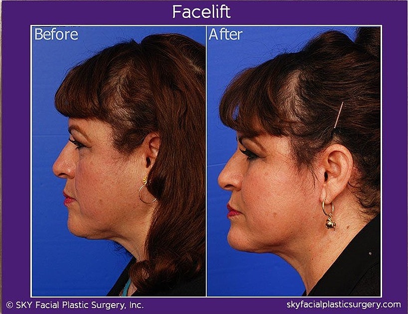 Facelift Before & After