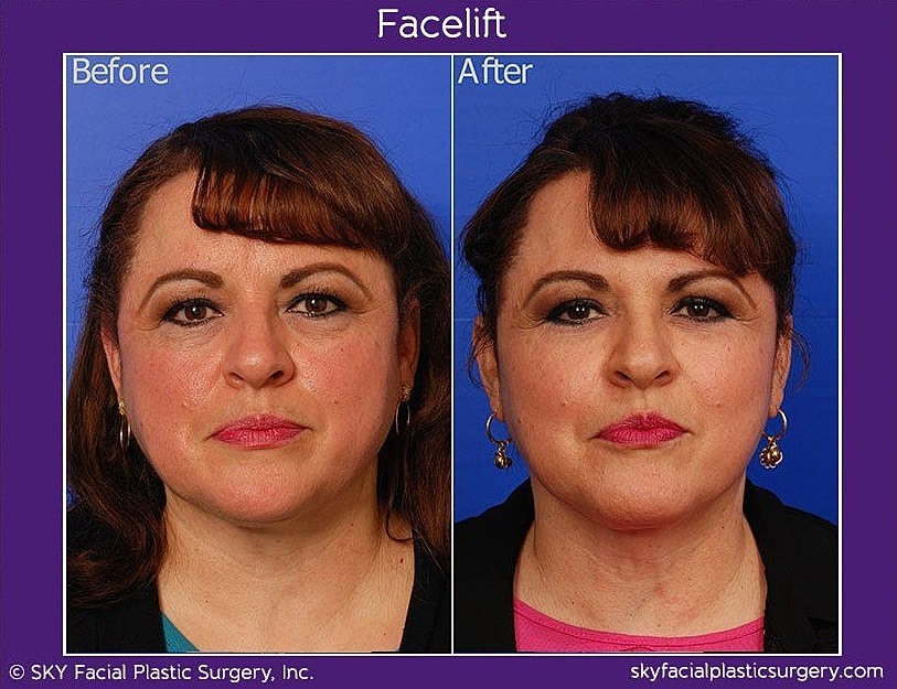 Facelift Before & After