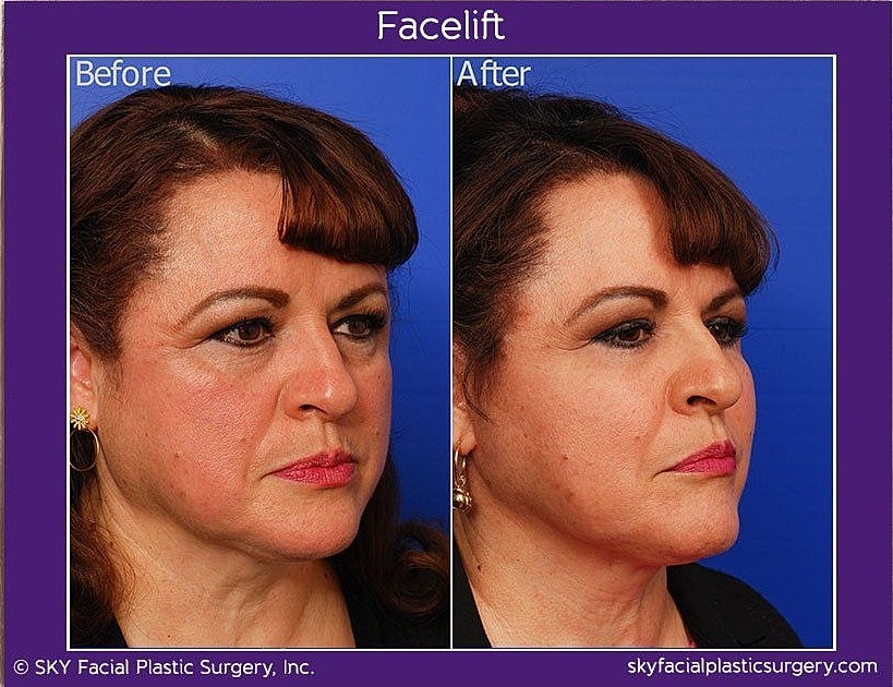 Facelift Before & After
