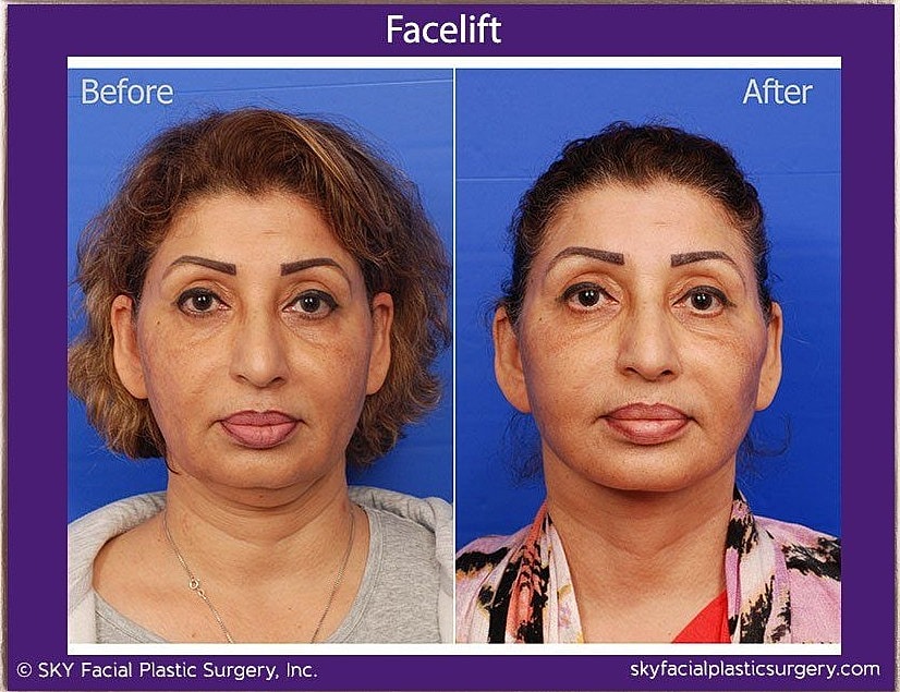 Facelift Before & After