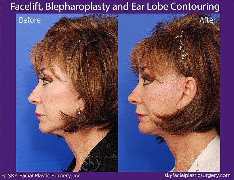 Facelift Before & After