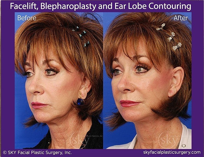 Facelift Before & After