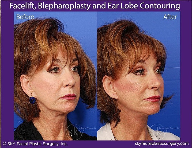 Facelift Before & After