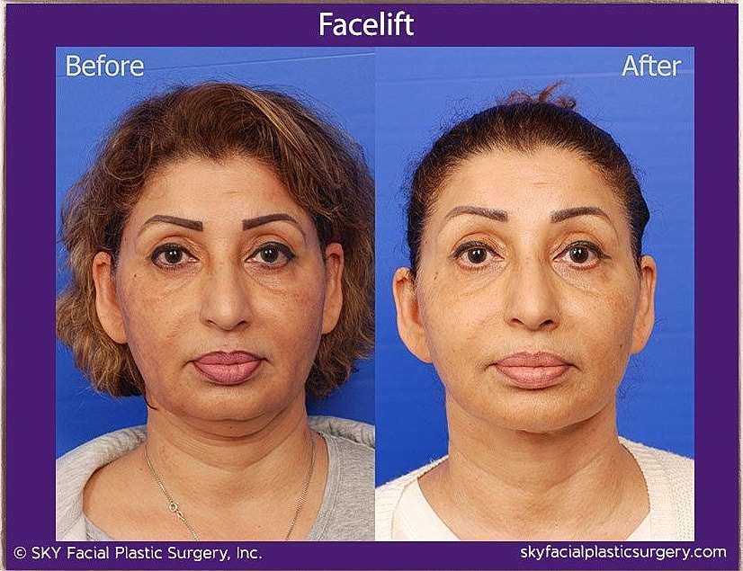 Facelift Before & After