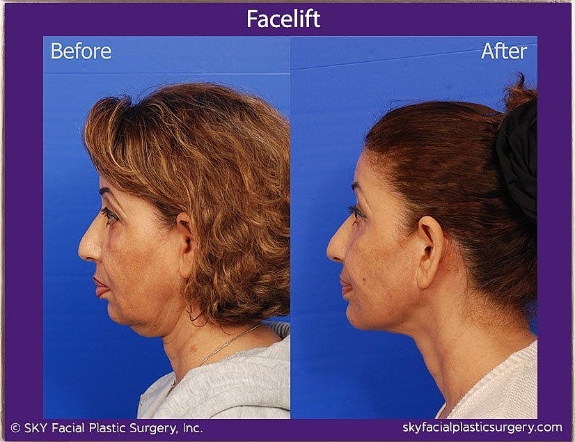 Facelift Before & After
