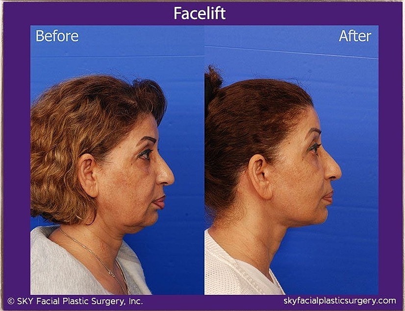Facelift Before & After