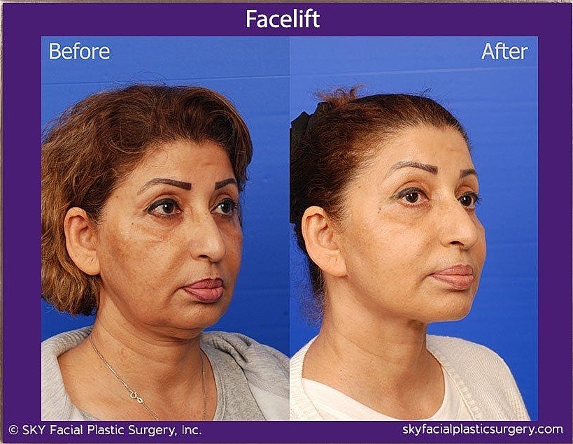 Facelift Before & After