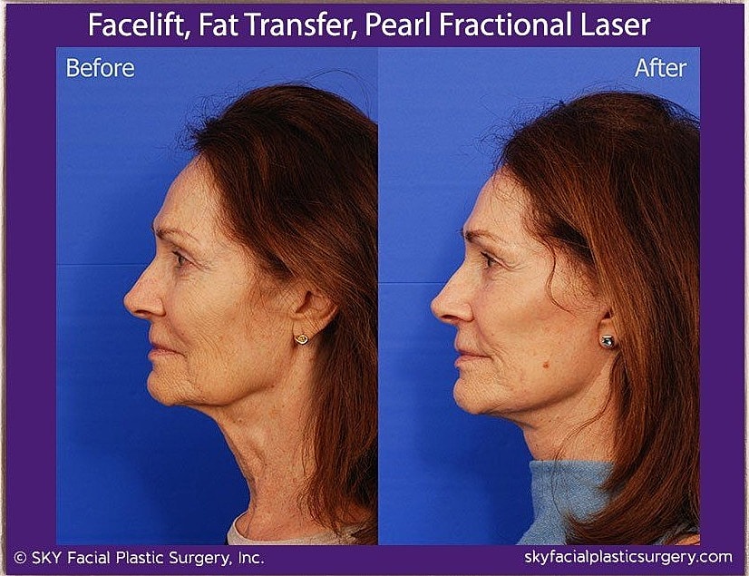 Facelift Before & After