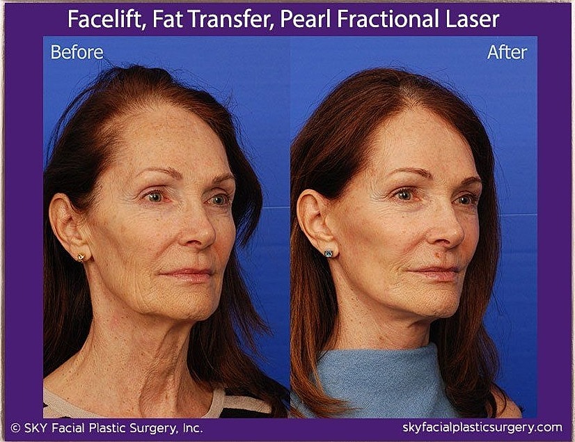 Facelift Before & After