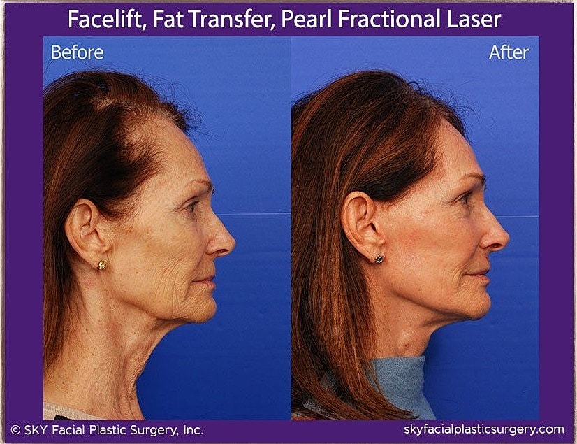 Facelift Before & After