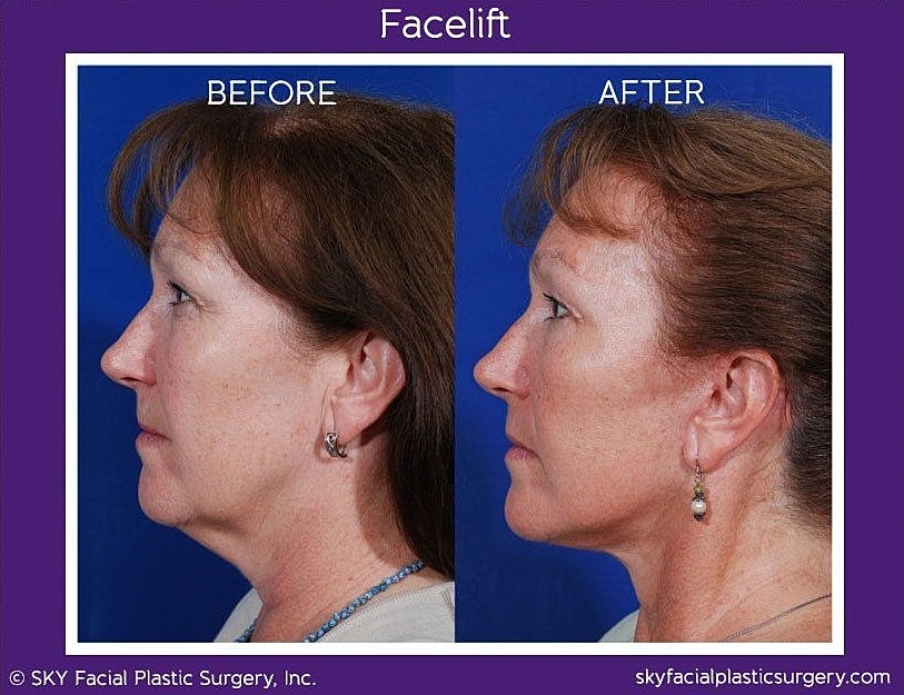 Facelift Before & After