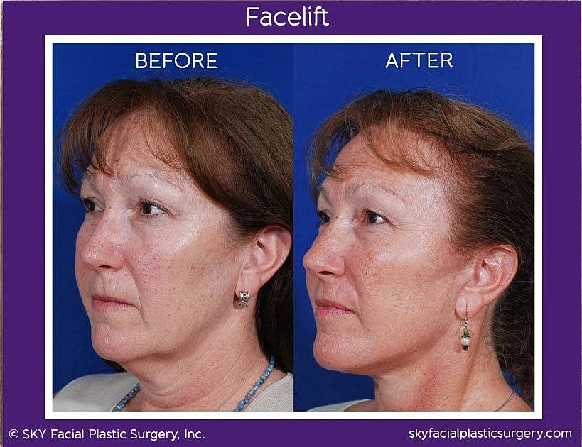 Facelift Before & After