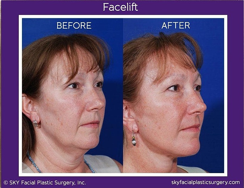 Facelift Before & After