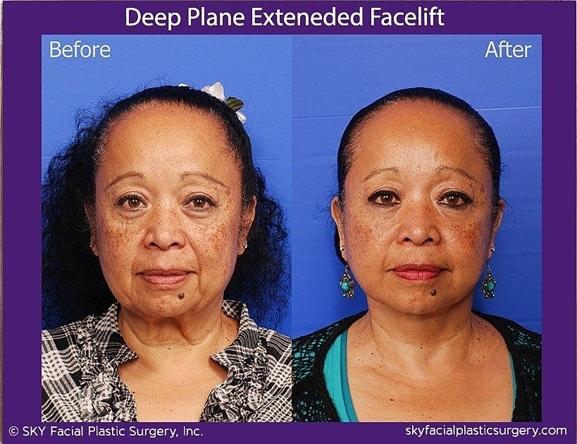 Facelift Before & After