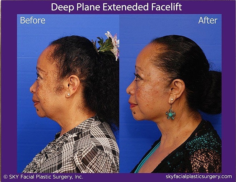 Facelift Before & After