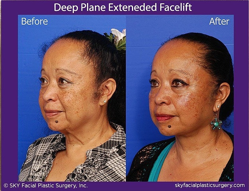 Facelift Before & After