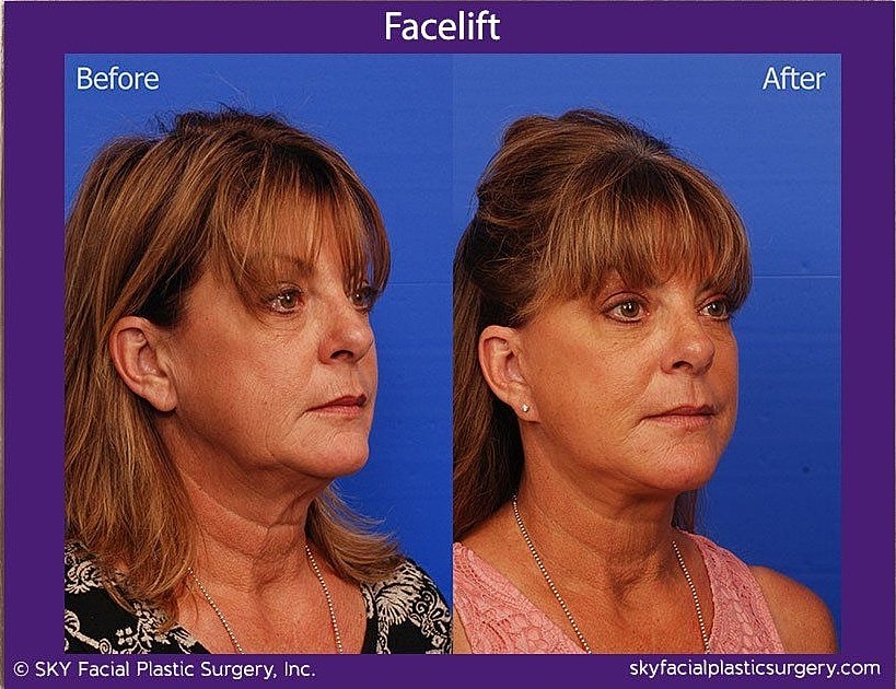 Facelift Before & After