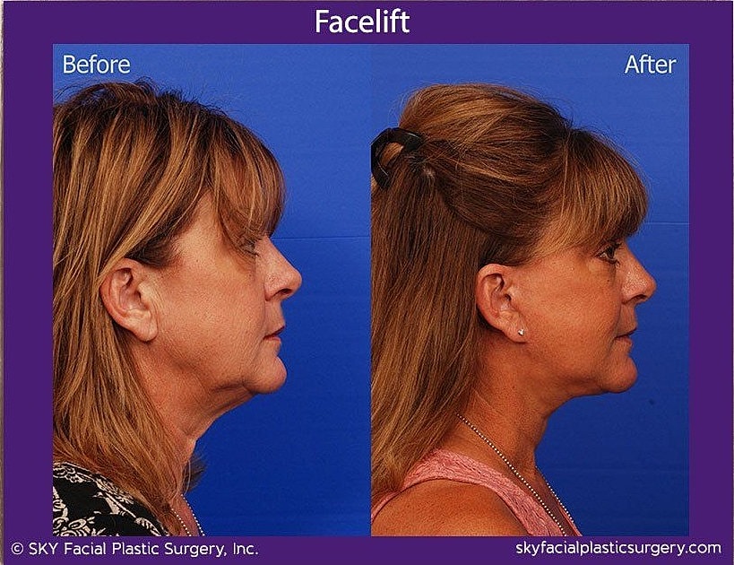 Facelift Before & After