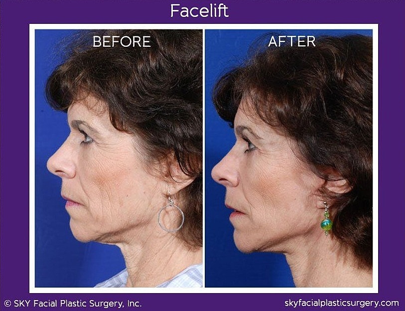 Facelift Before & After