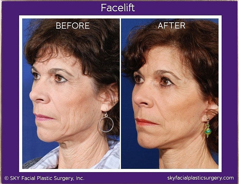 Facelift Before & After