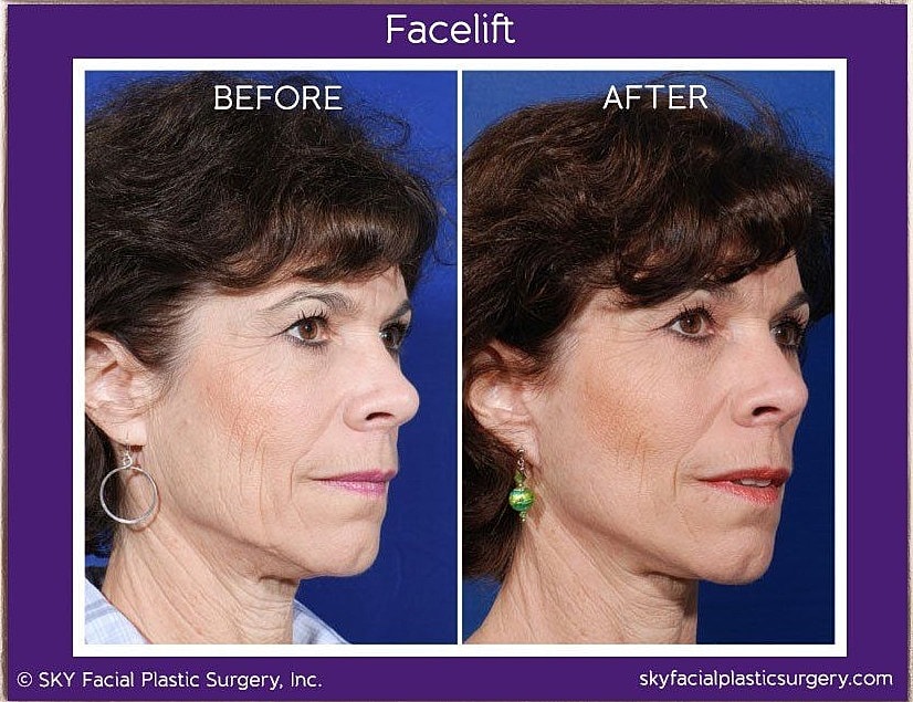 Facelift Before & After