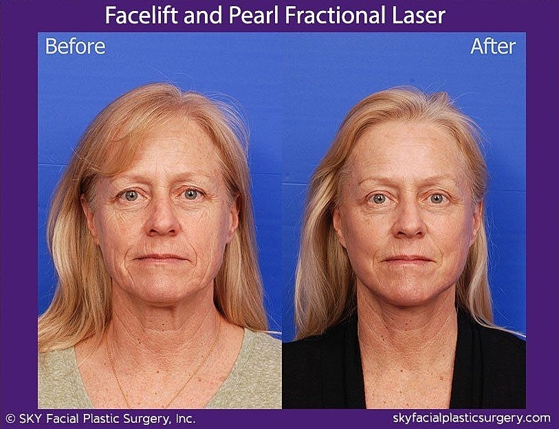 Facelift Before & After