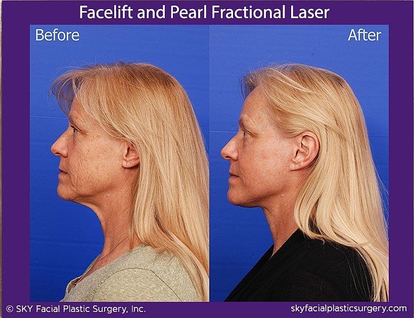 Facelift Before & After