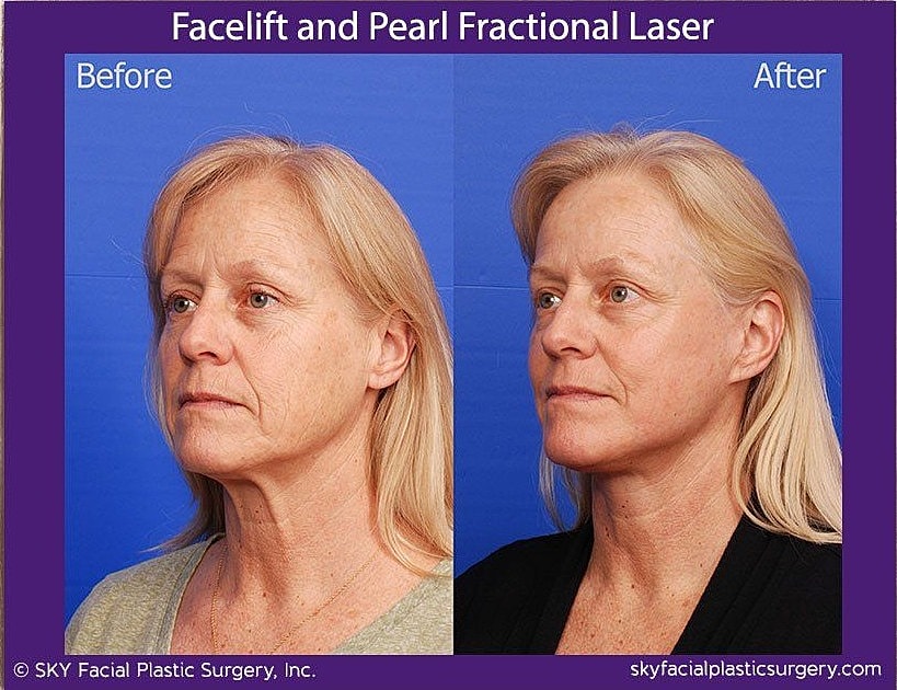 Facelift Before & After