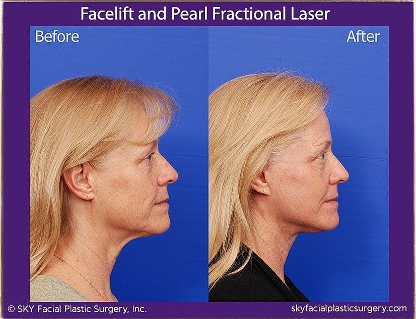 Facelift Before & After